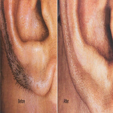 PRP Therapy for Hair Loss In Patiala