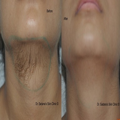 PRP Therapy for Hair Loss In Patiala