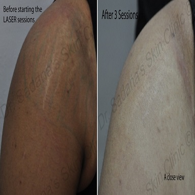 Stretch Marks Treatment Doctors in Patiala
