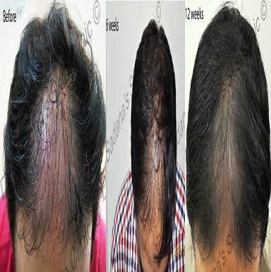 melanocyte cell transplantation for vitiligo in patiala