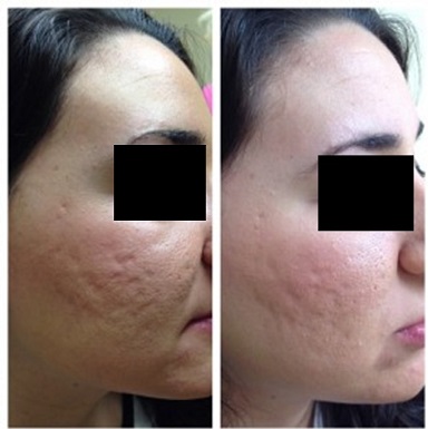 PRP treatment in Patiala