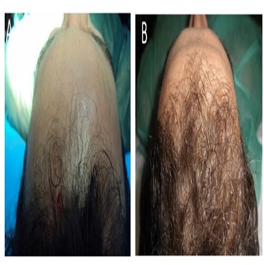 PRP treatment in Patiala