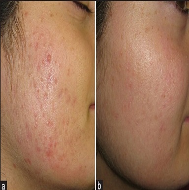 PRP treatment in Patiala