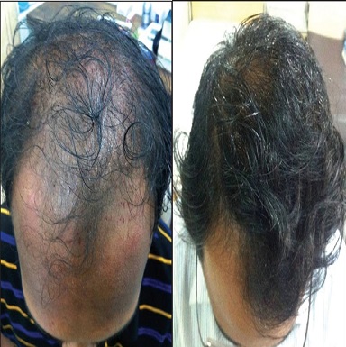 PRP treatment in Patiala