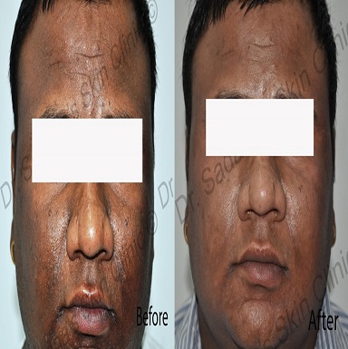 Stretch Marks Treatment Doctors in Patiala