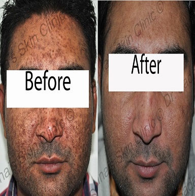 Stretch Marks Treatment Doctors in Patiala