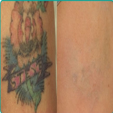 Stretch Marks Treatment Doctors in Patiala