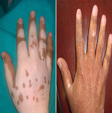 melanocyte cell transplantation for vitiligo in patiala