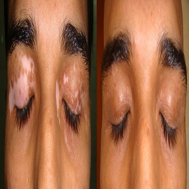 melanocyte cell transplantation for vitiligo in patiala
