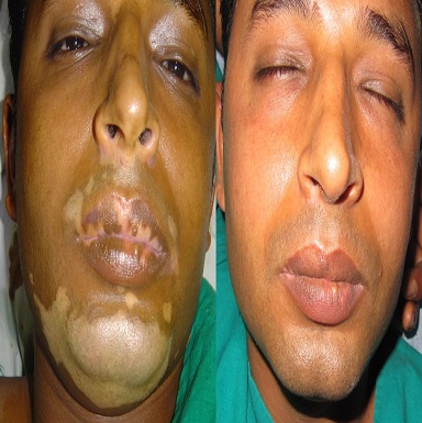 melanocyte cell transplantation for vitiligo in patiala