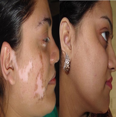 melanocyte cell transplantation for vitiligo in patiala